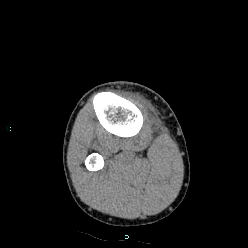File:Chronic osteomyelitis (with Brodie abscess) (Radiopaedia 76405-88111 A 57).jpg