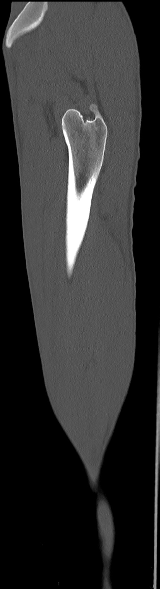 Chronic osteomyelitis (with sequestrum) (Radiopaedia 74813-85822 C 19).jpg