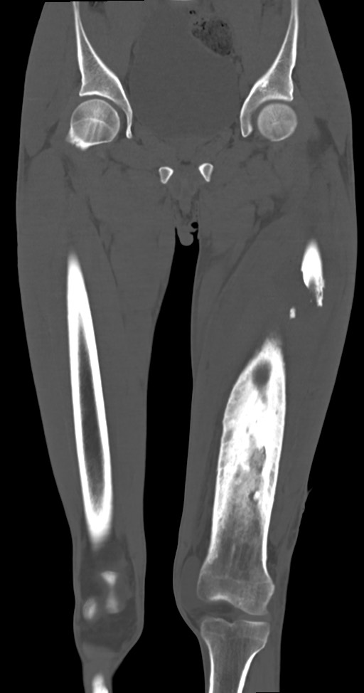 Chronic osteomyelitis (with sequestrum) (Radiopaedia 74813-85822 Coronal non-contrast 22).jpg