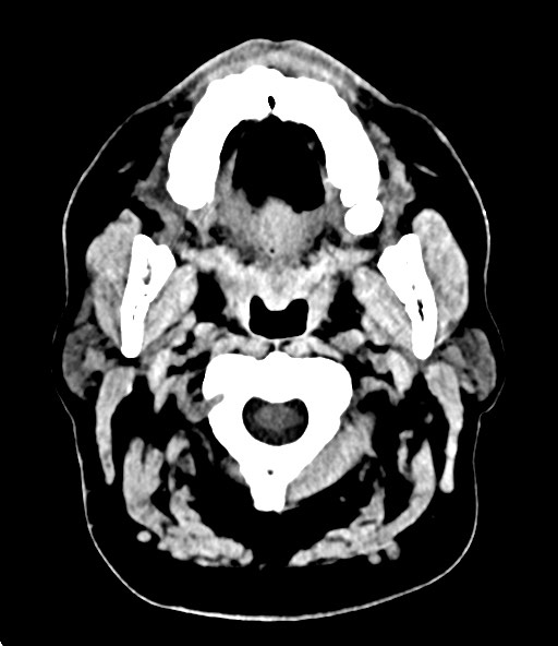 File:Chronic osteomyelitis - calvarial (severe) (Radiopaedia 69668-79616 Axial non-contrast 16).jpg
