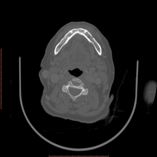 Chronic osteomyelitis - maxilla (Radiopaedia 23783-23927 Axial bone window 24).jpg