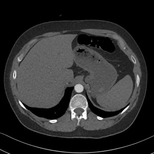 Chronic pulmonary embolus (Radiopaedia 39129-41341 Axial C+ CTPA 93).png