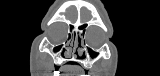 Chronic sphenoidal sinusitis (Radiopaedia 62030-70122 Coronal bone window 34).jpg