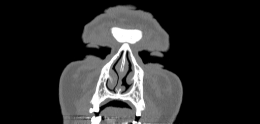 Chronic sphenoidal sinusitis (Radiopaedia 62030-70122 Coronal bone window 8).jpg