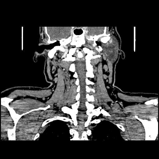 File:Chronic submandibular abscess (Radiopaedia 21738-21718 B 24).jpg