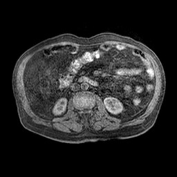 Cirrhosis and hepatocellular carcinoma in the setting of hemochromatosis (Radiopaedia 75394-86594 Axial T1 C+ fat sat 8).jpg