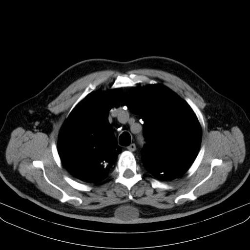 Classic complicated silicosis (Radiopaedia 49720-54961 Axial liver window 14).jpg