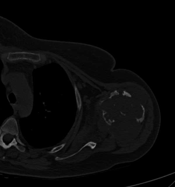 Clear cell chondrosarcoma - humerus (Radiopaedia 63104-71612 Axial bone window 52).jpg