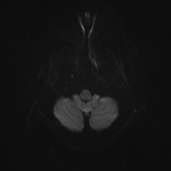 File:Clival meningioma (Radiopaedia 53278-59248 Axial DWI 27).jpg