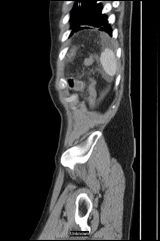 Closed loop bowel obstruction and ischemia (Radiopaedia 86959-103180 C 2).jpg