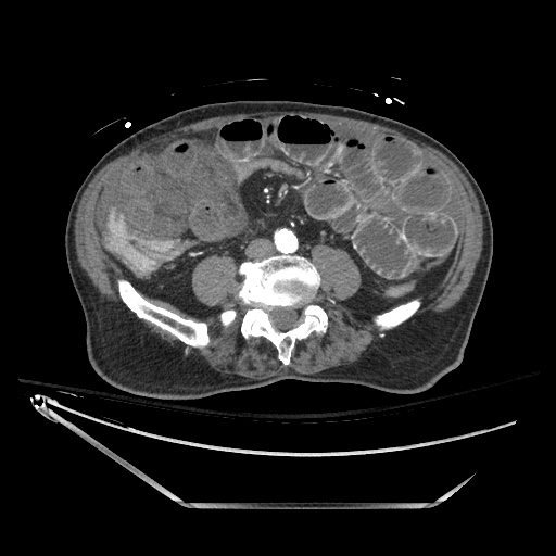 Closed loop obstruction due to adhesive band, resulting in small bowel ischemia and resection (Radiopaedia 83835-99023 B 93).jpg