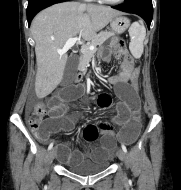Closed loop small bowel obstruction (Radiopaedia 71211-81508 B 37).jpg