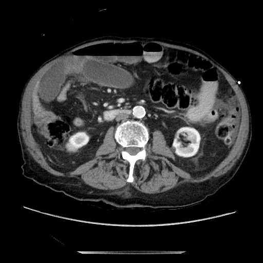 Closed loop small bowel obstruction - adhesive disease and hemorrhagic ischemia (Radiopaedia 86831-102990 A 96).jpg