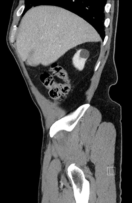 Closed loop small bowel obstruction - internal hernia (Radiopaedia 57806-64778 C 92).jpg