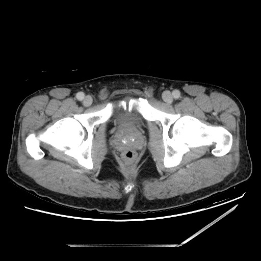 Closed loop small bowel obstruction - omental adhesion causing "internal hernia" (Radiopaedia 85129-100682 A 167).jpg