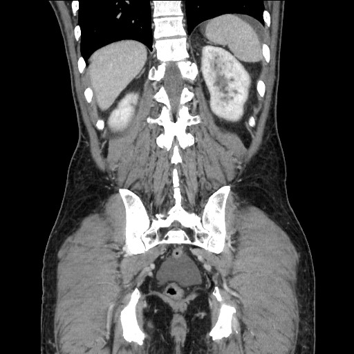 Closed loop small bowel obstruction - omental adhesion causing "internal hernia" (Radiopaedia 85129-100682 B 100).jpg