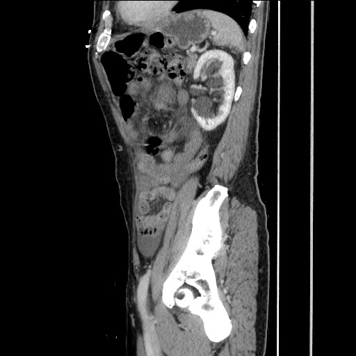File:Closed loop small bowel obstruction - omental adhesion causing "internal hernia" (Radiopaedia 85129-100682 C 131).jpg