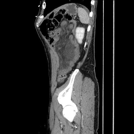 Closed loop small bowel obstruction - omental adhesion causing "internal hernia" (Radiopaedia 85129-100682 C 146).jpg