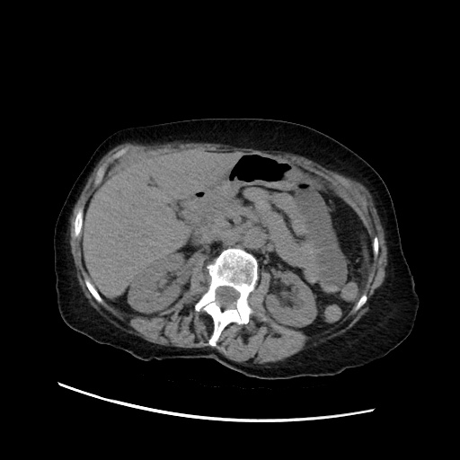 File:Closed loop small bowel obstruction due to adhesive band, with intramural hemorrhage and ischemia (Radiopaedia 83831-99017 Axial non-contrast 63).jpg