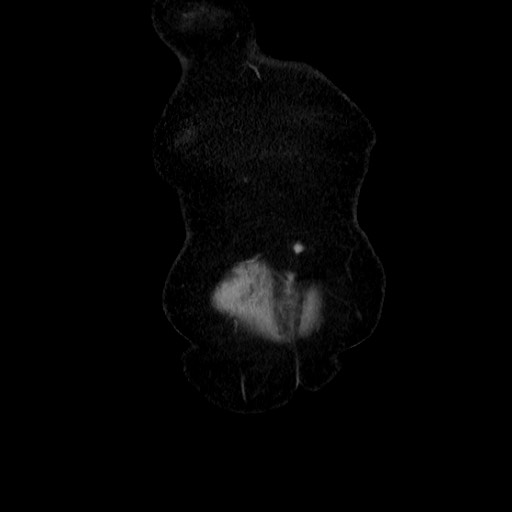 File:Closed loop small bowel obstruction due to adhesive band, with intramural hemorrhage and ischemia (Radiopaedia 83831-99017 C 13).jpg