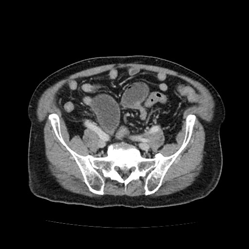 File:Closed loop small bowel obstruction due to adhesive band - U-shaped loop (Radiopaedia 83829-99012 A 49).jpg