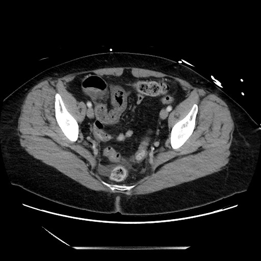 Closed loop small bowel obstruction due to adhesive bands - early and late images (Radiopaedia 83830-99014 A 131).jpg