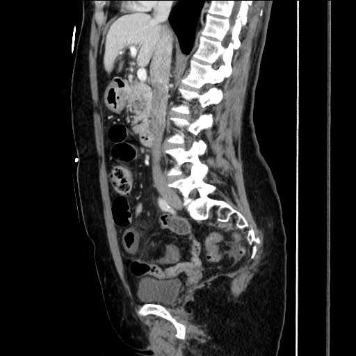 File:Closed loop small bowel obstruction due to adhesive bands - early and late images (Radiopaedia 83830-99014 C 84).jpg