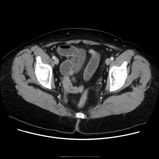 Closed loop small bowel obstruction due to adhesive bands - early and late images (Radiopaedia 83830-99015 A 150).jpg