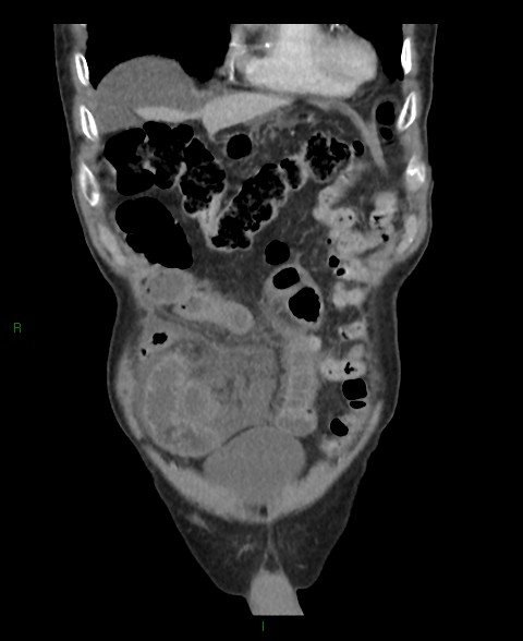 Closed loop small bowel obstruction with ischemia (Radiopaedia 84180-99456 B 54).jpg