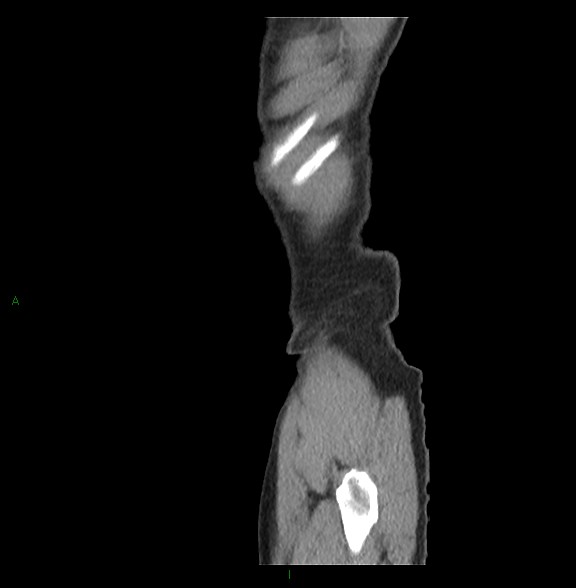 Closed loop small bowel obstruction with ischemia (Radiopaedia 84180-99456 C 91).jpg