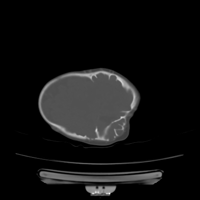 Cloverleaf skull (Radiopaedia 91901-109710 Axial bone window 125).jpg