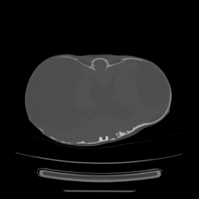 Cloverleaf skull (Radiopaedia 91901-109710 Axial bone window 93).jpg