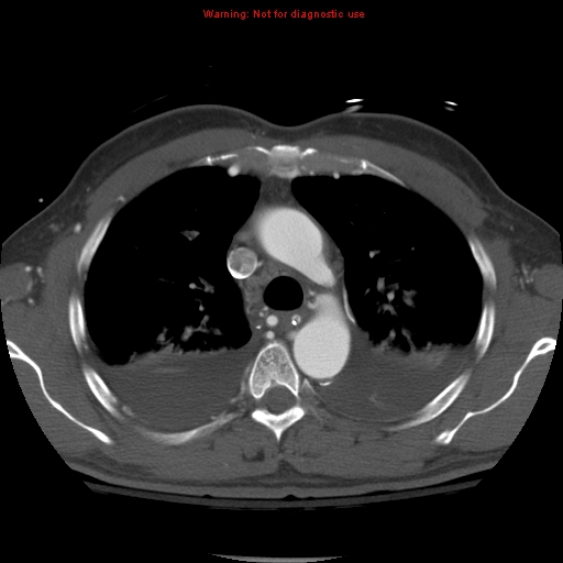 File:Coarctation of the aorta (Radiopaedia 8681-9490 B 23).jpg