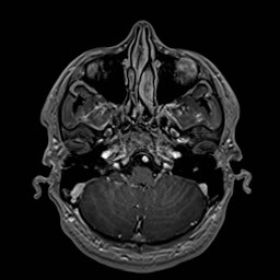 File:Cochlear incomplete partition type III associated with hypothalamic hamartoma (Radiopaedia 88756-105498 Axial T1 C+ 51).jpg