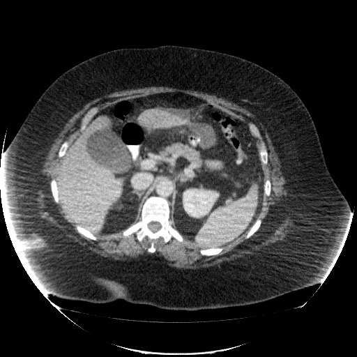 File:Collection due to leak after sleeve gastrectomy (Radiopaedia 55504-61972 A 28).jpg