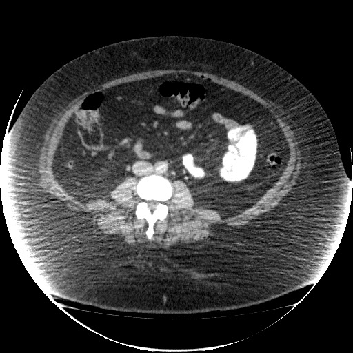 File:Collection due to leak after sleeve gastrectomy (Radiopaedia 55504-61972 A 46).jpg