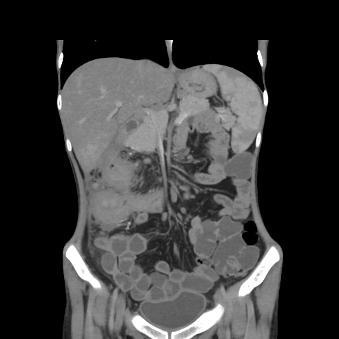 File:Colocolic fistula - Crohn disease (Radiopaedia 57063-63955 B 17).jpg