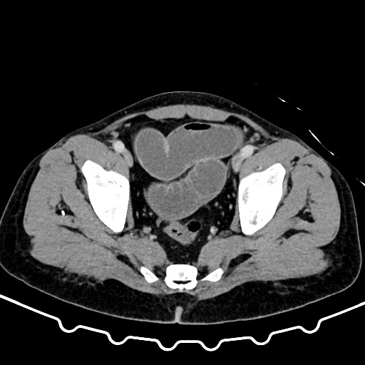 File:Colocolic intussusception due to large lipoma (Radiopaedia 68773-78482 A 169).jpg