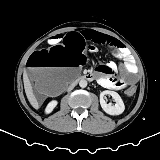 Colocolic intussusception due to large lipoma (Radiopaedia 68773-78482 A 82).jpg