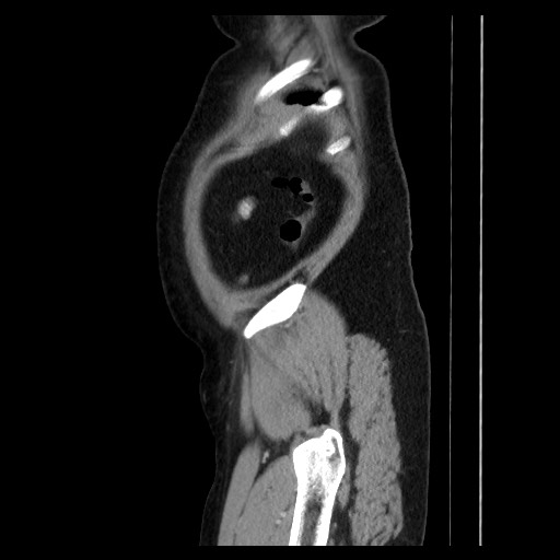 Colocolic intussusception due to tubular adenoma (Radiopaedia 73744-84551 C 138).jpg