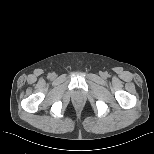 File:Colon adenocarcinoma - splenic flexure (Radiopaedia 34143-35406 Axial Oral contrast 91).png