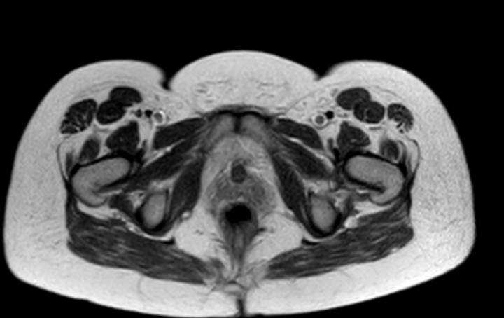 Colon adenocarcinoma with Krukenberg tumors, advanced pregnancy (Radiopaedia 67279-76645 Axial T2 3).jpg