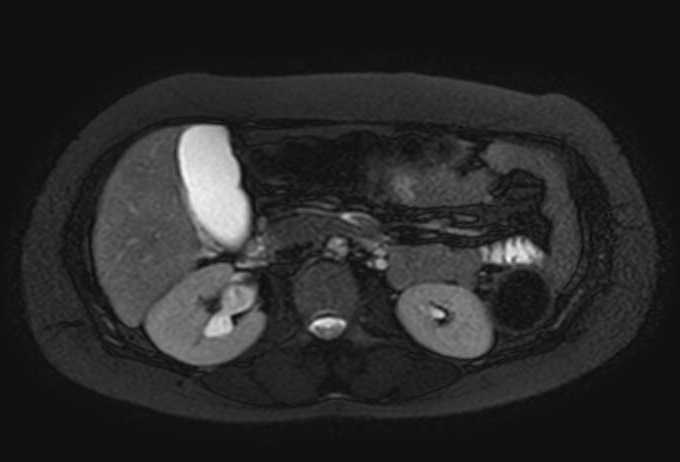 File:Colon adenocarcinoma with Krukenberg tumors, advanced pregnancy (Radiopaedia 67279-76645 Axial T2 SPAIR 51).jpg