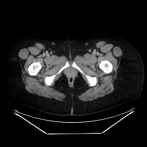 File:Colonic intussusception due to adenocarcinoma (Radiopaedia 86828-102987 A 155).jpg