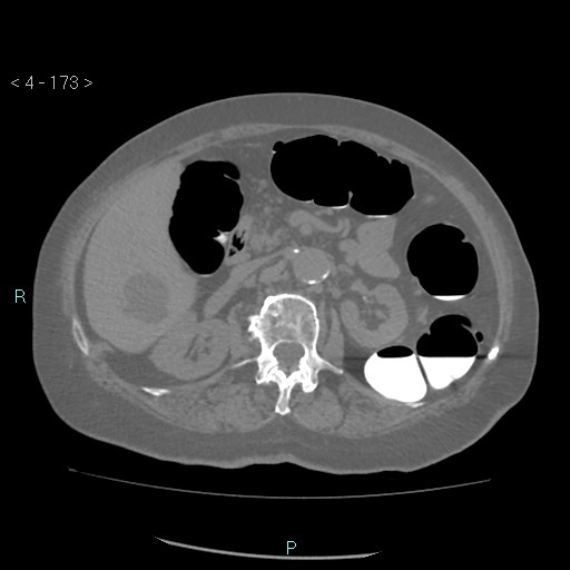 Colonic lipomas (Radiopaedia 49137-54244 Axial bone window 77).jpg