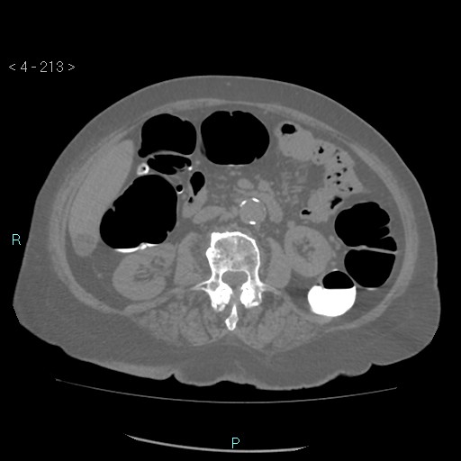 Colonic lipomas (Radiopaedia 49137-54244 Axial bone window 95).jpg