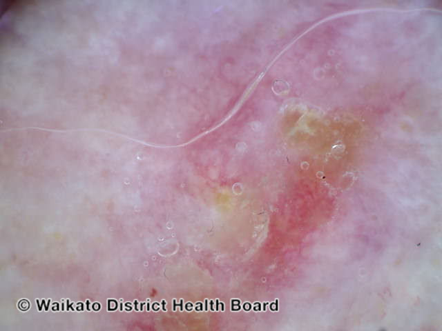 File:Dermoscopy view (DermNet NZ acanthoma-fissuratum-03).jpg