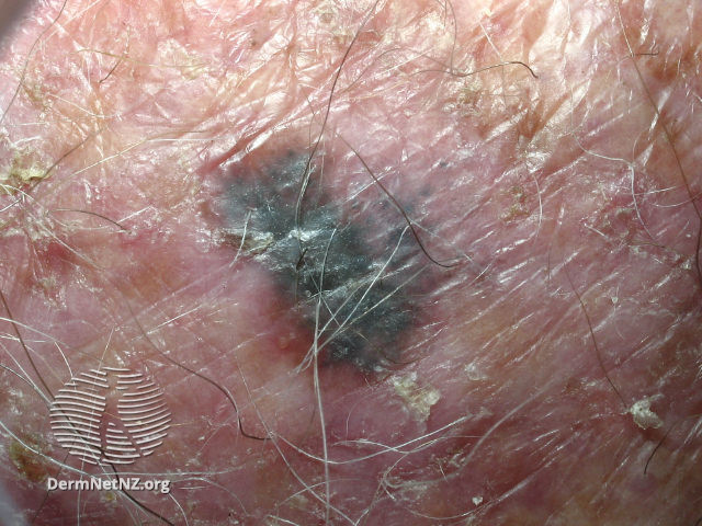 File:Melanoma in situ (DermNet NZ melanoma-abcd-14).jpg