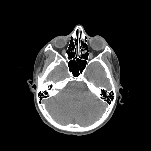 Nasal pyogenic granuloma (lobular capillary hemangioma) (Radiopaedia 85536-101244 Axial non-contrast 92).jpg
