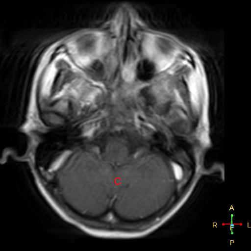 File:Nasopharyngeal carcinoma infiltrating the clivus (Radiopaedia 25229-25481 Axial T1 C+ 7).jpg